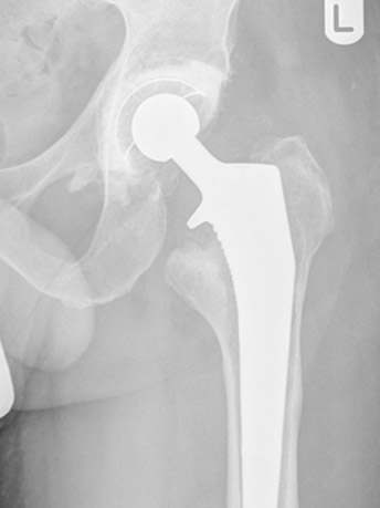 Revision Hip for aseptic loosening of stem and socket