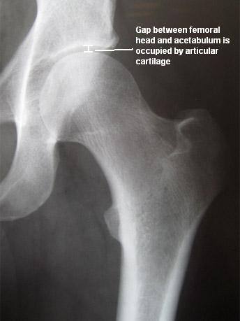 femur x ray